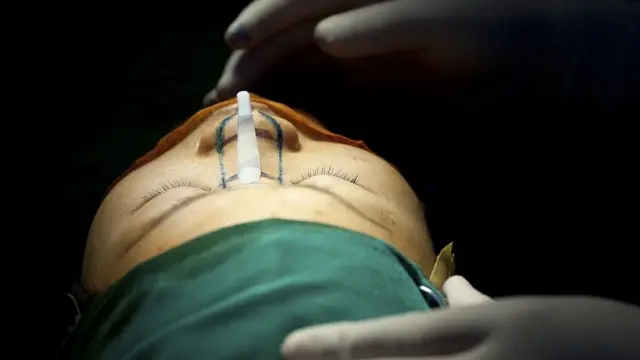 چین، کاسمیٹک سرجری