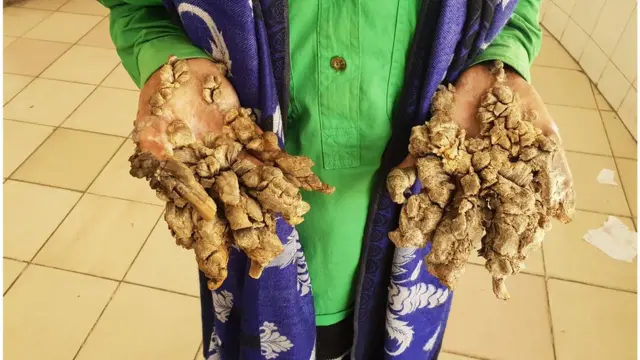 দীর্ঘদিন চিকিৎসা না নেয়ার কারণে আবুল বাজানদারের হাতে আবারও আগের মতো শেকড় গজিয়ে গেছে।