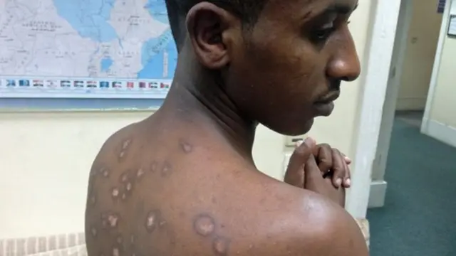 ''ኣስገርቲ ኣብ ሕቖን ውሽጣዊ ሰለፍን ዝነድድ ፕላስቲክ ይፈስሱለይ፡ ኣነ ድማ ብቃንዛ እጭድርን እጭድርን ነይረ''