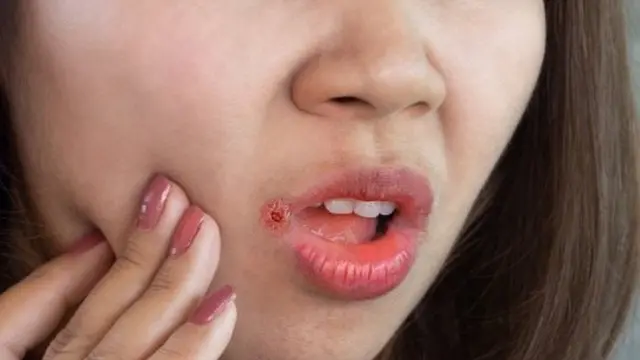 শুষ্ক ঠোঁটে দেখা দিতে পারে নানা সমস্যা