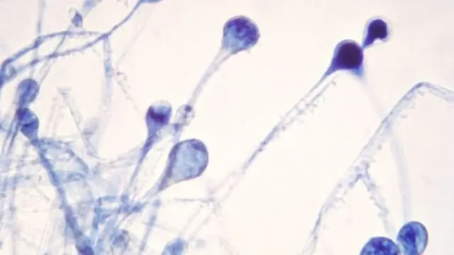 மியூகார்மைகோஸிஸ்