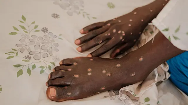 Harkaa fi miila nama dhibichaan qabamee