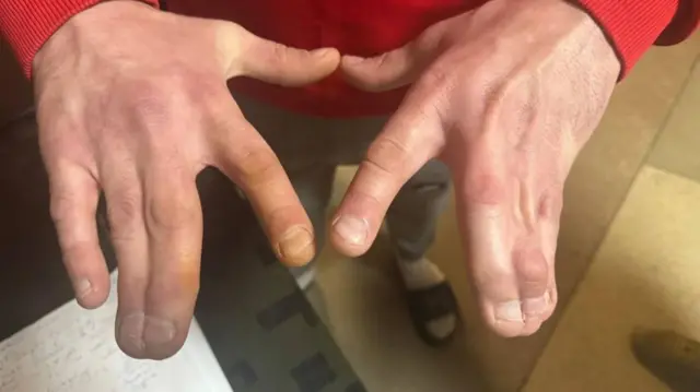 На цьому фото видно пальці рук чоловіка, деякі з яких зрощені, скоріше за все, із дитинства