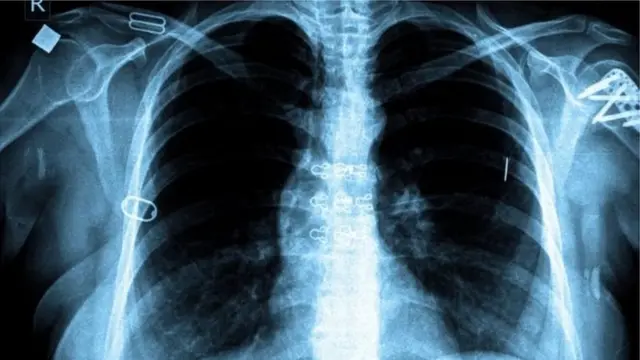 La tuberculose pulmonaire est la forme de tuberculose la plus répandue dans le monde.