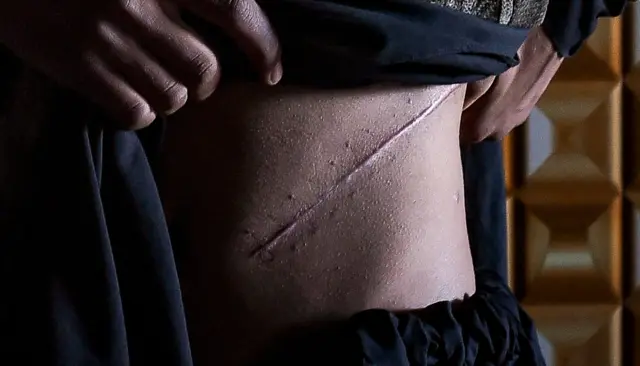 Close up of man's torso as he lifts his clothing to revealing a diagonal scar, that runs from the centre of his stomach to his side. He was photographed in Afghanistan in 2022, Getty reports that he sold his kidney in an attempt to save his family from starvation.