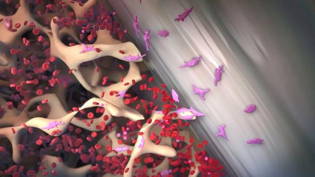 Representação do osteossarcoma