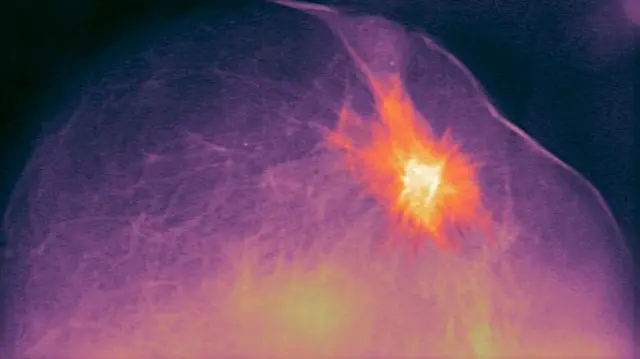 Breast Cancer - Adenocarcinoma of di right breast. 