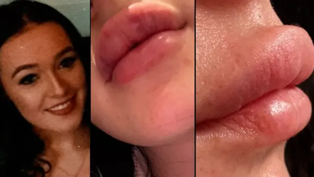 با آنکه امروزه تزریق ژل لب به طور فزاینده‌ای محبوبیت یافته، اما برای بسیاری از افراد درد و احساس خجالت‌زدگی از ظاهرشان را در پی داشته است