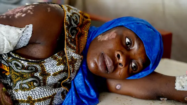 Sifa Mohammed est allongée sur un lit d'hôpital, coiffée d'un foulard bleu et d'une robe à motifs, avec des bandages sur les bras et des marques de brûlures sur la peau.