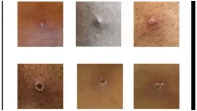 મંકીપૉક્સ