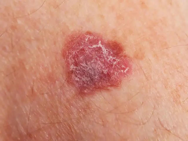 புற்றுநோய் 