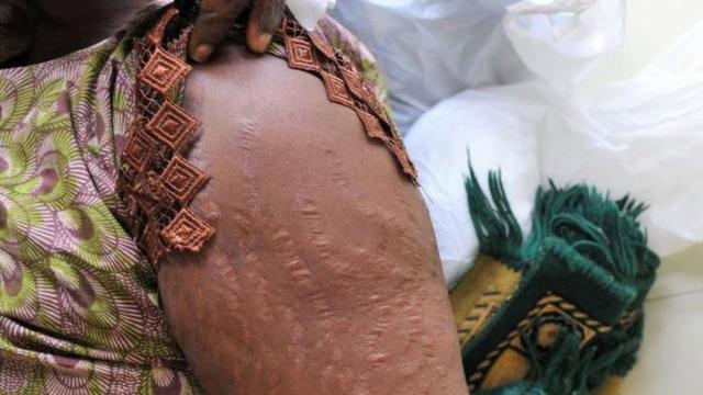 Une femme montre des cicatrices sur son bras dans un hôpital de Dakar causées par l'éclaircissement de la peau.