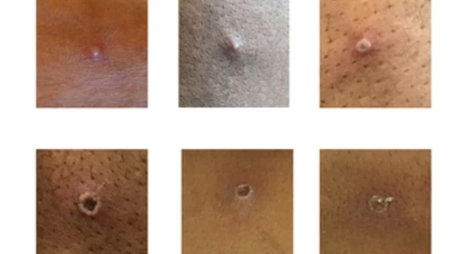 የቫይረሱ ምልክት