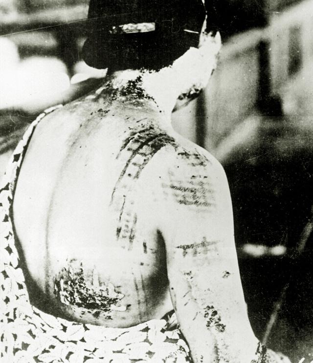 广岛一名女性在原子弹爆炸中受伤，她的皮肤被灼伤