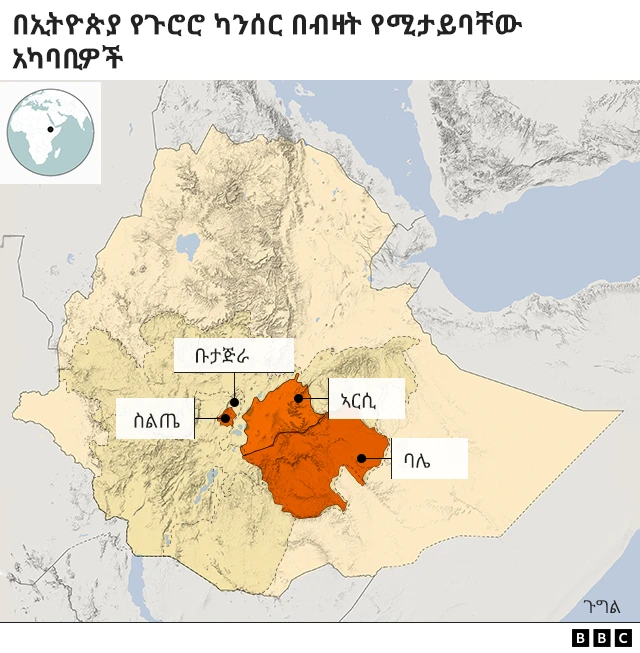 የጉሮሮ ካንሰር ኢትዮጵያ ውስጥ በተወሰኑ አካባቢዎች ብቻ ላይ ይስተዋላል።