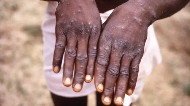 فيروس جدري القرود