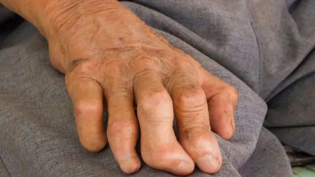 mano con dedos deformados.