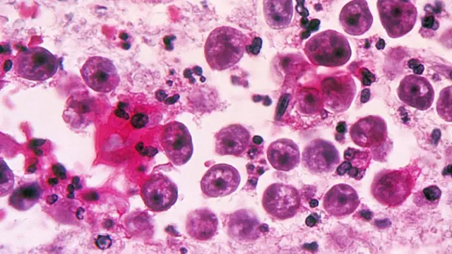 A microscopic image of a Naegleria fowleri amoeba infection