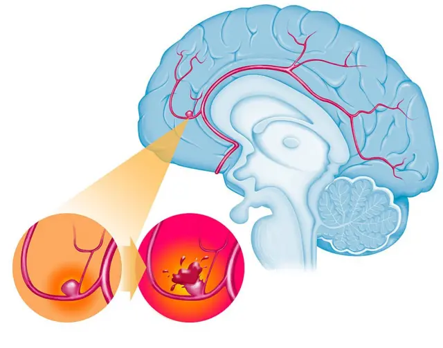 What is Brain Aneurysm