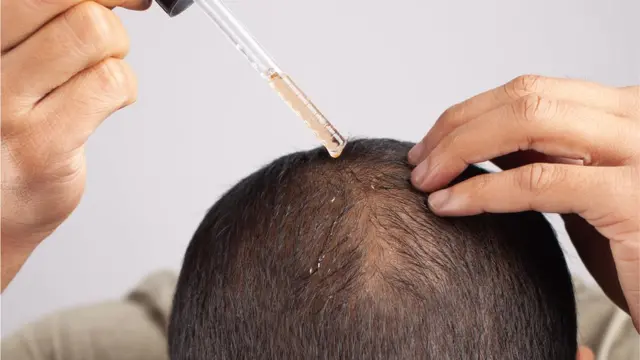 Homem aplicando medicamento líquido no couro cabeludo