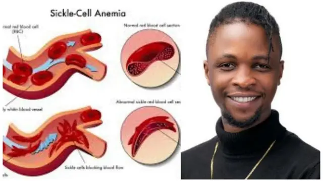 SC Genotype: Nkan tó yẹ kí o mọ̀ nípa ààrùn Sickle Cell 'SC' tí Laycon BBNaija ní