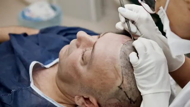'Hair transplant'