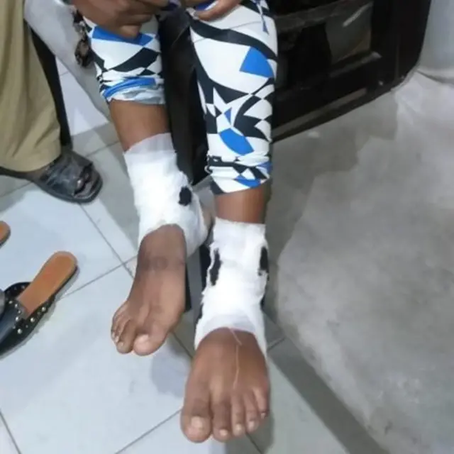 Les chaînes aux chevilles de Farah ont laissé des blessures qui ont dû être pansées.