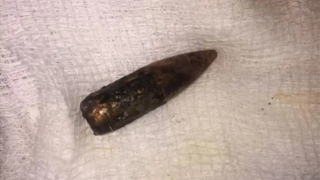 शरीर से निकाली गई गोली
