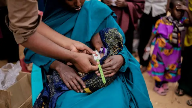 Malnourished child in Mandera, Kenya