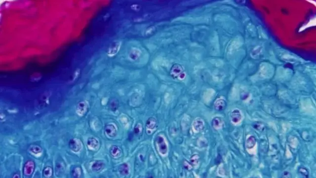 मंकीपॉक्स वायरस