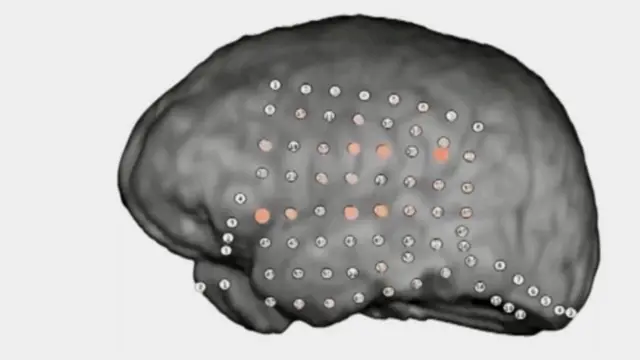 Patrones de actividad en un cerebro humano cuando es sometido a una prueba auditiva.