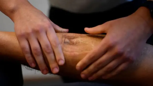 آسیب عصبی باعث شد تا پای چپ سباستین بلین از زانو به پایین بیحس شود