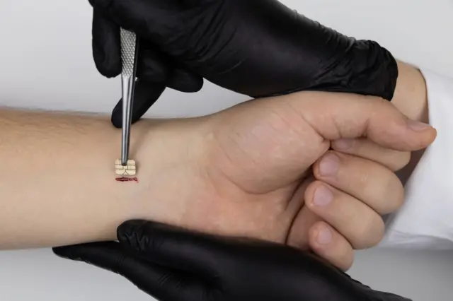 ማይክሮቺፕ ሲቀበር