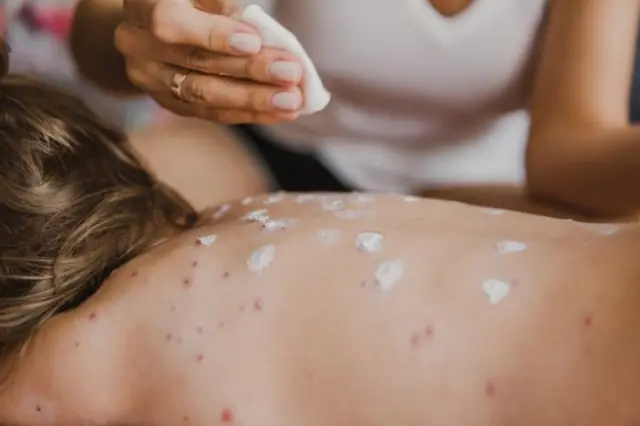 गोवर हा साथीचा आजार आहे, जो पॅरामिक्सोव्हायरस मुळे पसरतो.