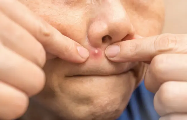 चेहऱ्यावरची मुरमं-पिंपल्स थुंकी लावून जातात? पिंपल्स का येतात? थुंकी औषधी असते का?