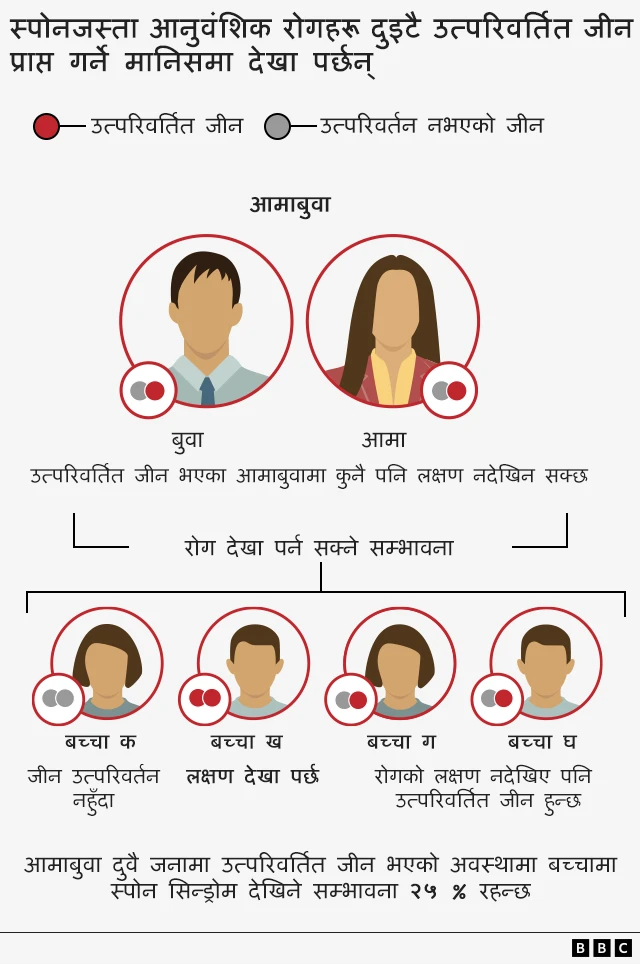 स्पोअन सिन्ड्रम कसरी हुन्छ भनेर देखाइएको ग्राफिक