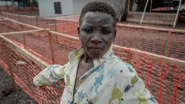 Onye nwere ọrịa mpox