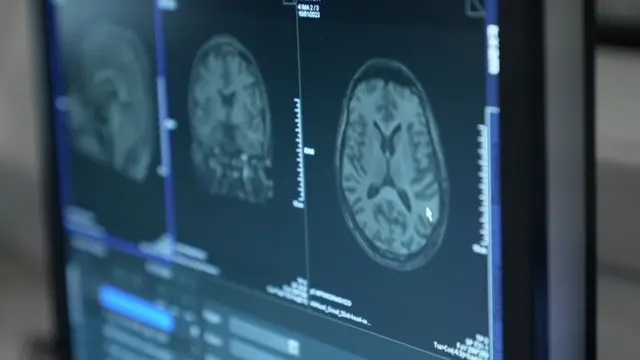 Images du cerveau sous scanner