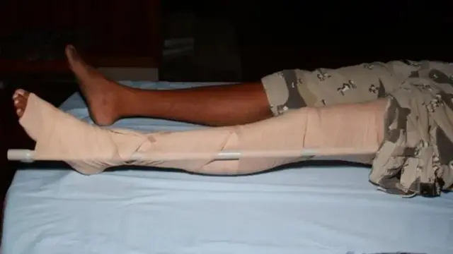 பாம்புக்கடி