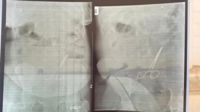 X-ray scan wey show surgical item inside di deceased belle