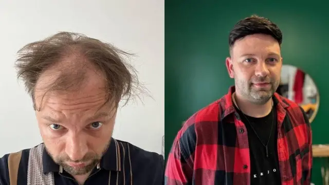 Luke Shepherd antes y después de hacerse una prótesis capilar