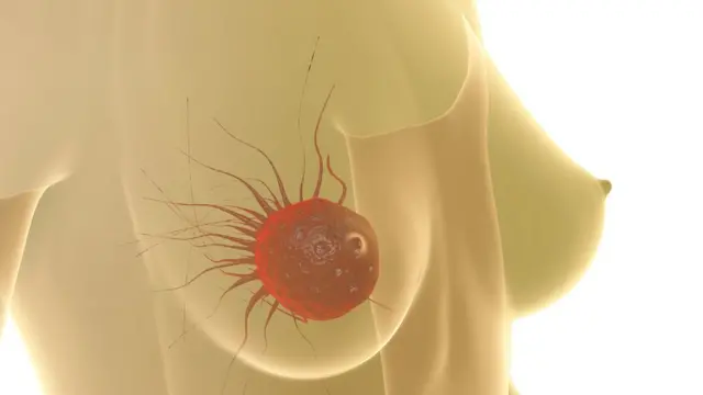 Gráfico de un cáncer de seno