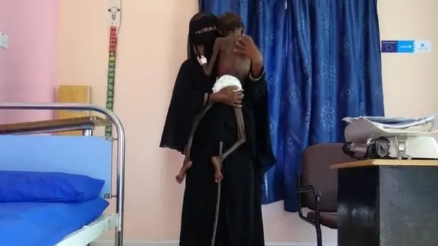 ஏமனில் ஊட்டச்சத்தின்மையால் பாதிப்புக்குள்ளான குழந்தை.