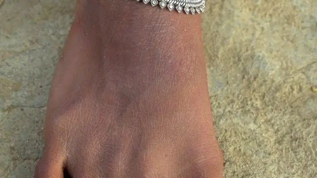 కాలిన గాయం మచ్చ ఆధారంగా