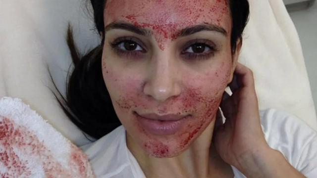 Kim Kardashian em foto publicada após procedimento