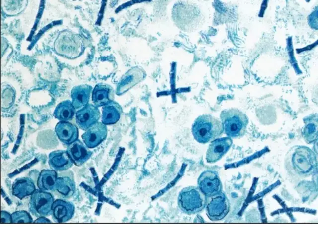 ஆந்த்ராக்ஸ் பாக்டீரியா 