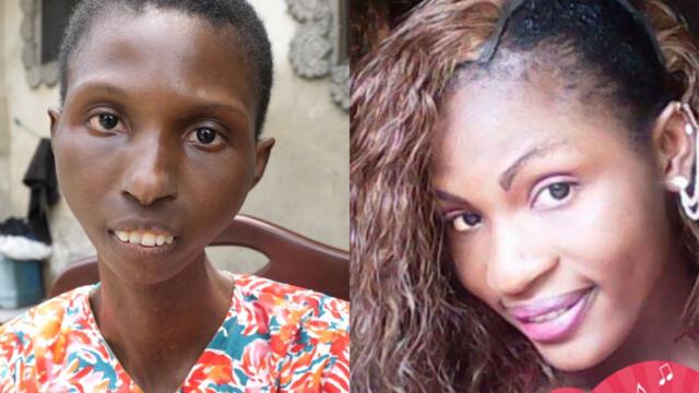 Scleroderma: 'I dey fear to look mirror say fine girl like me don turn to  anoda thing' - BBC News Pidgin