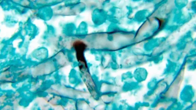 వైట్ ఫంగస్