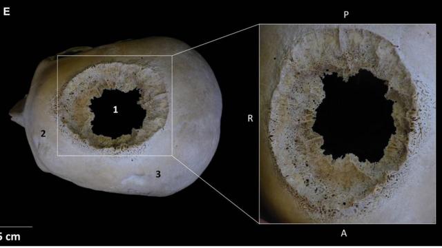 Cráneo con evidencia de lesión por cirugía 