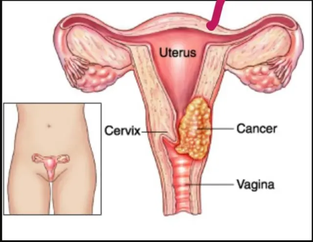 Suuraa kaansarii fiixee gadaameessaa agarsiisu